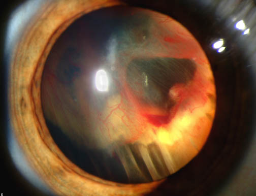 Slit-lamp photograph of retinal detachment in Von Hippel–Lindau disease