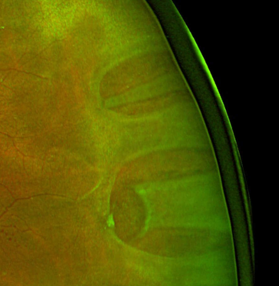 Fundus photograph showing a horseshoe retinal tear with surrounding detachment