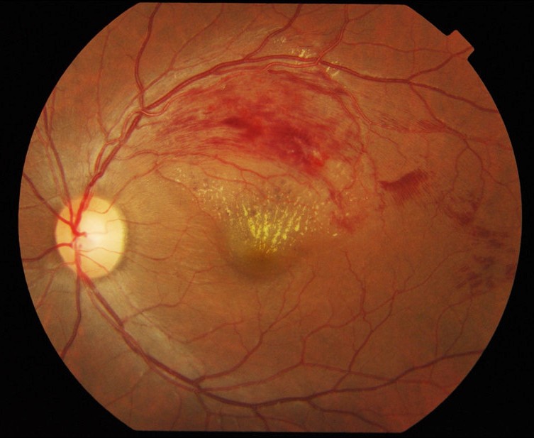 Color fundus photograph showing branch retinal vein occlusion with sectoral hemorrhages and exudates.