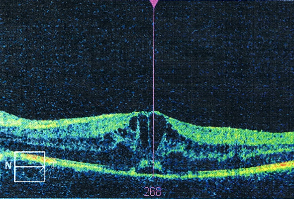OCT scan showing cystoid macular edema, a common complication after retinal vein occlusion.