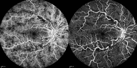 Fluorescein angiography images demonstrating blocked and leaking retinal vessels in central retinal vein occlusion.