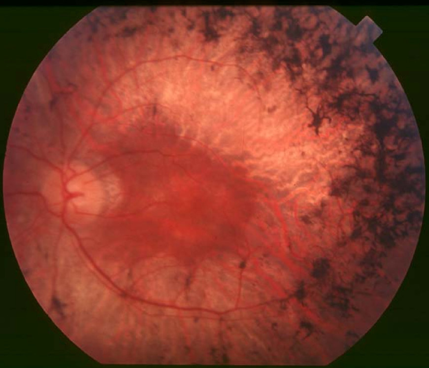 Fundus photograph showing mid-stage retinitis pigmentosa with bone-spicule pigmentation and vessel attenuation