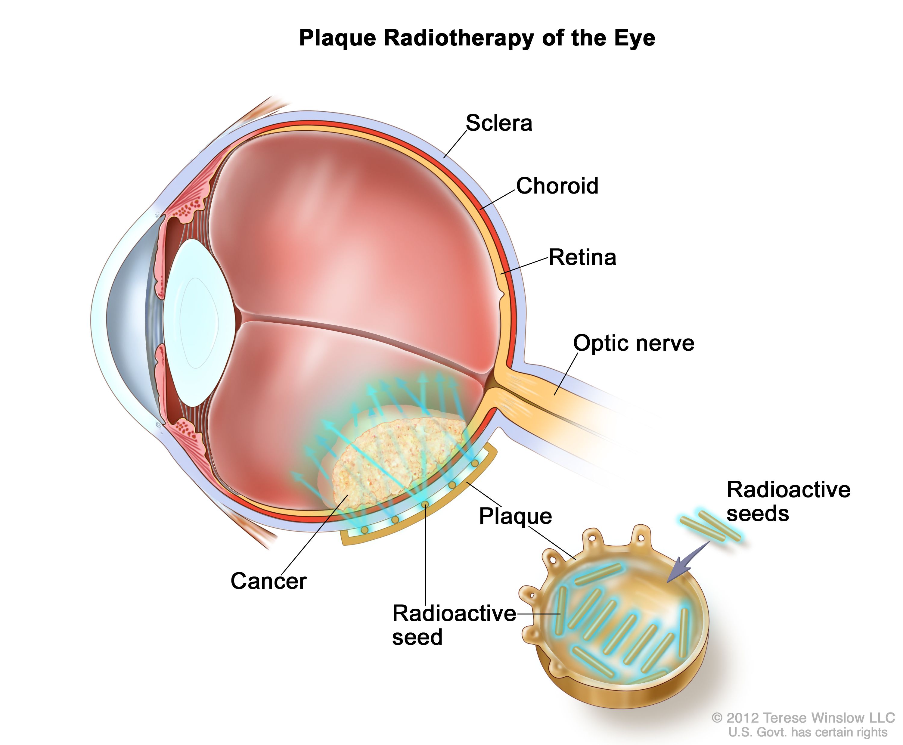 Diagram of plaque radiotherapy for an eye tumor with labeled sclera, choroid, retina, optic nerve, and radioactive seeds