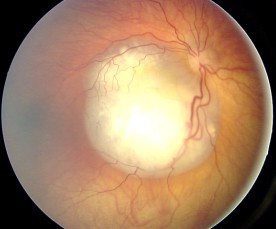 Fundus photograph showing a whitish retinal mass consistent with retinoblastoma