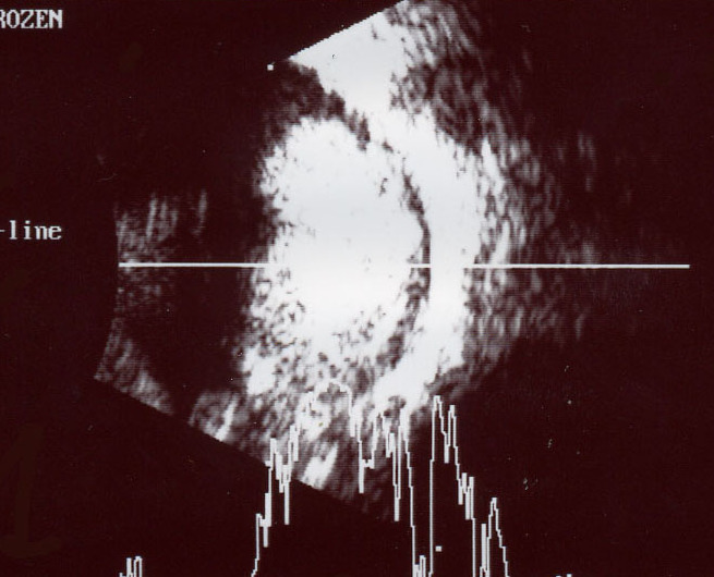 Ocular ultrasound image showing a mass with internal reflectivity typical of retinoblastoma