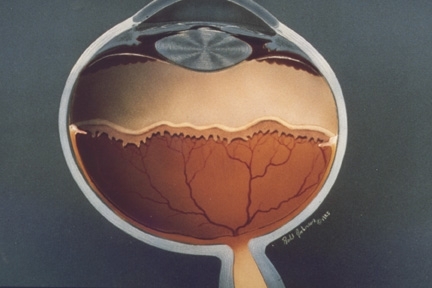 Illustration of an infant eye showing a ridge of abnormal vessel growth in ROP