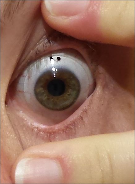 Eye wearing a clear scleral lens