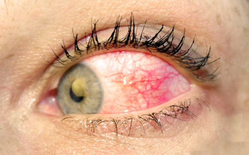 Macro photo of nodular scleritis with raised scleral nodule