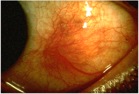 Close-up photograph showing violaceous redness from diffuse anterior scleritis