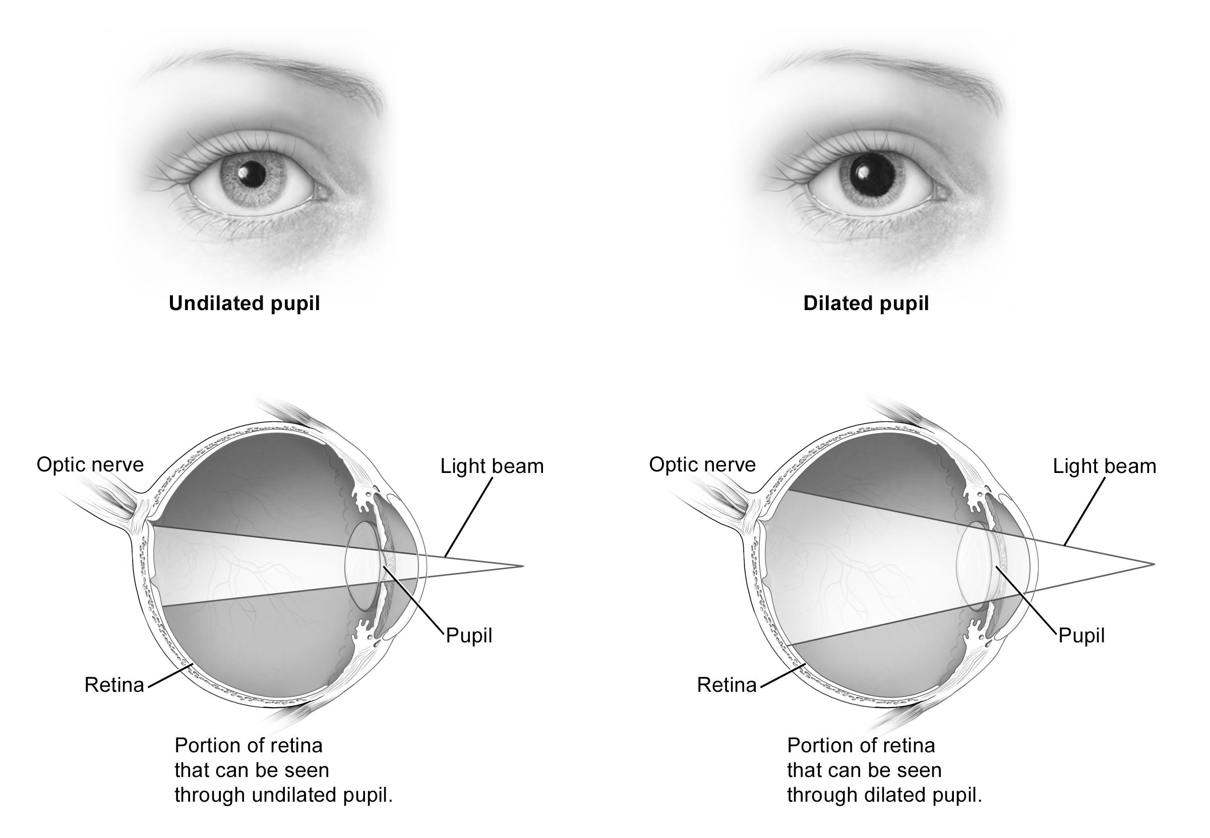 Dilated versus undilated pupil illustration
