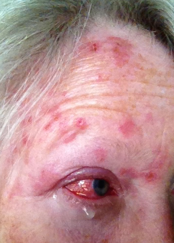 Day-7 shingles lesions with crusted vesicles on the brow and swollen eyelids.