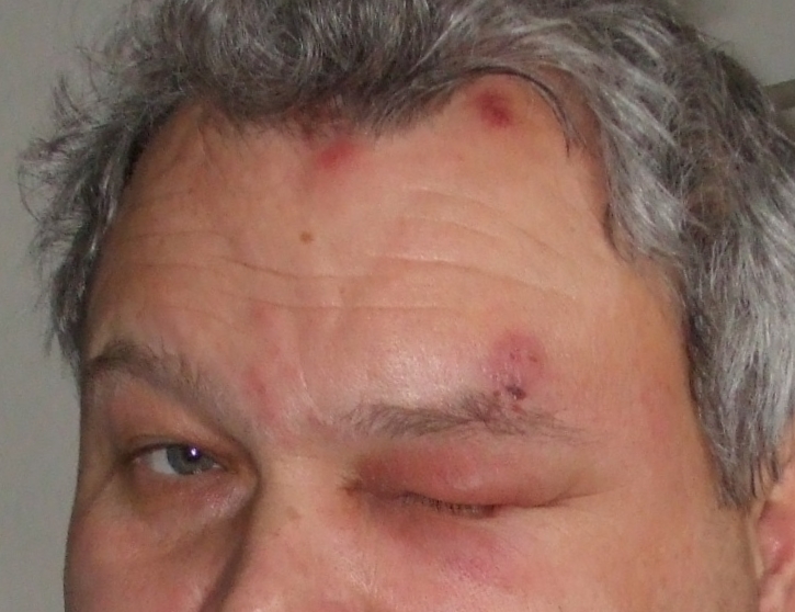 Close-up photo showing shingles rash affecting the forehead and upper eyelid in herpes zoster ophthalmicus.