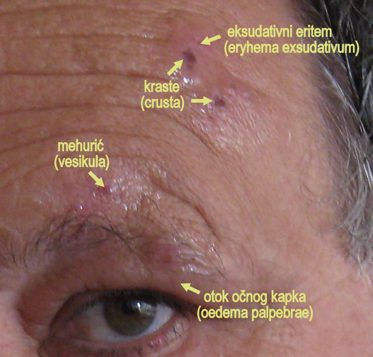 Clinical image illustrating widespread shingles rash over the forehead and nose, sparing the lower face.