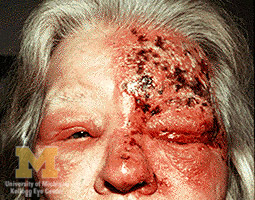 Color photograph of a reddened eye with corneal haze from trigeminal herpes causing uveitis and keratitis.