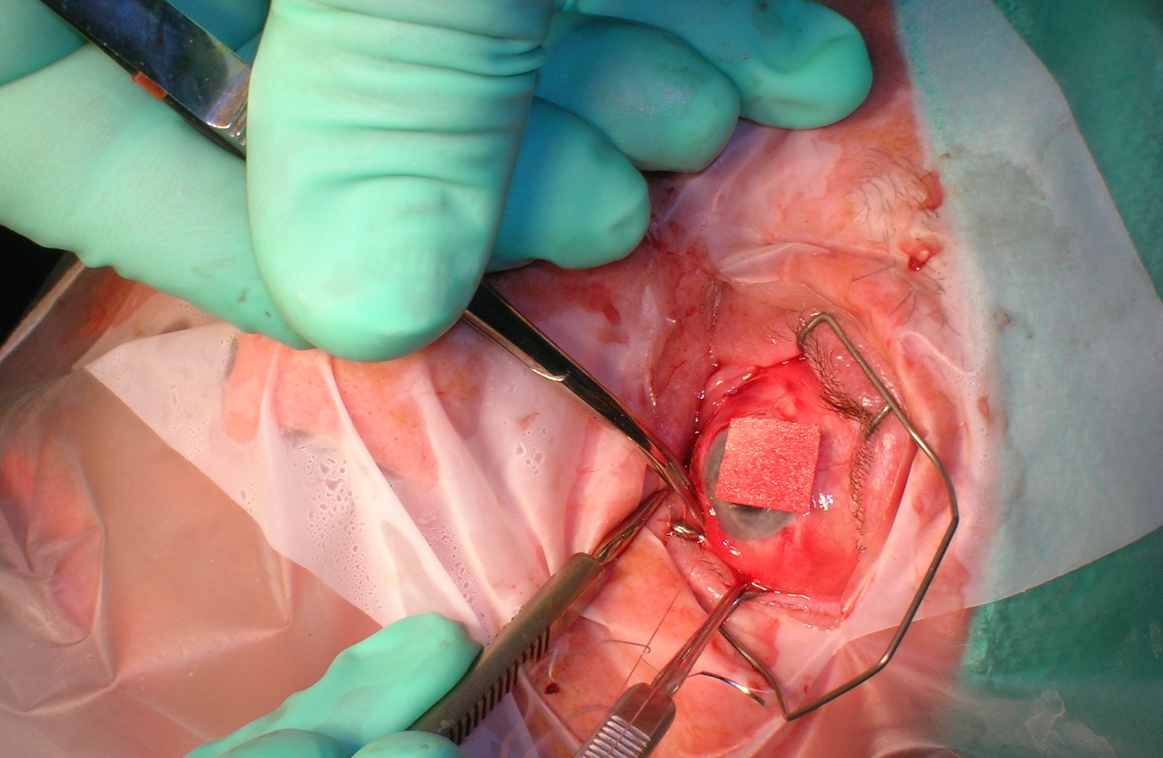 Surgeon performing laser eye procedure