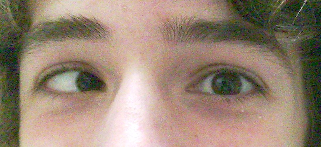 Close-up photo of a young person showing esotropia of the right eye.