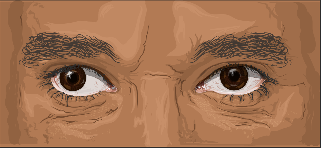 Illustration of eyes misaligned outward (exotropia).