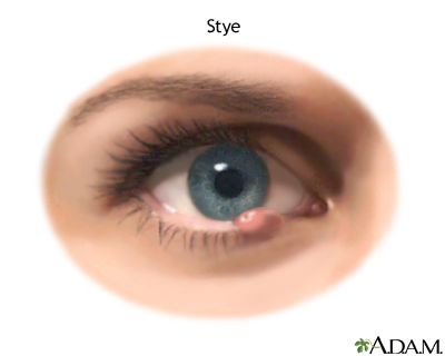 Illustration of a lower-eyelid stye showing a red bump near the lash line