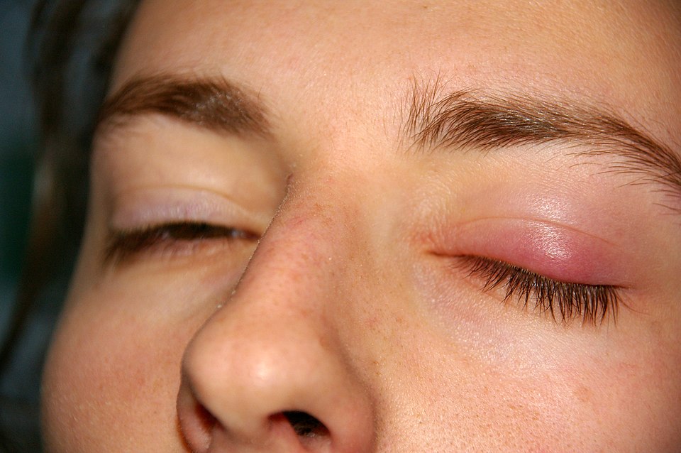 Upper eyelid with a swollen pink chalazion