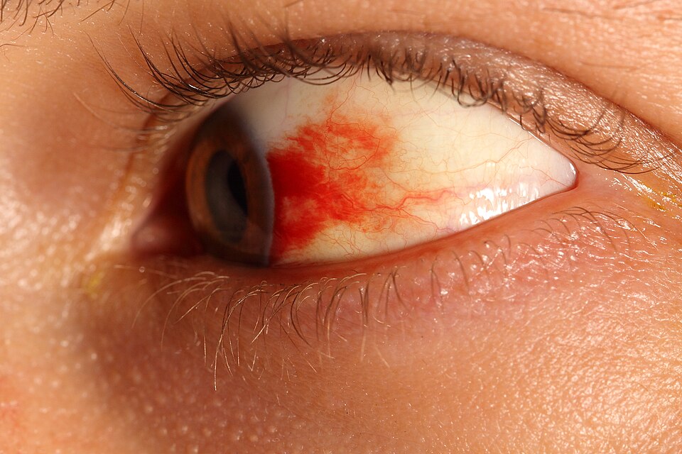 Close-up photograph of an eye with a bright red subconjunctival hemorrhage.