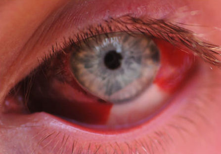 Before-and-after images showing a hemorrhage on day 1 and resolution at four weeks.