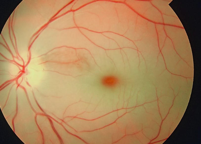 Fundus photo showing cherry-red spot typical of central retinal artery occlusion