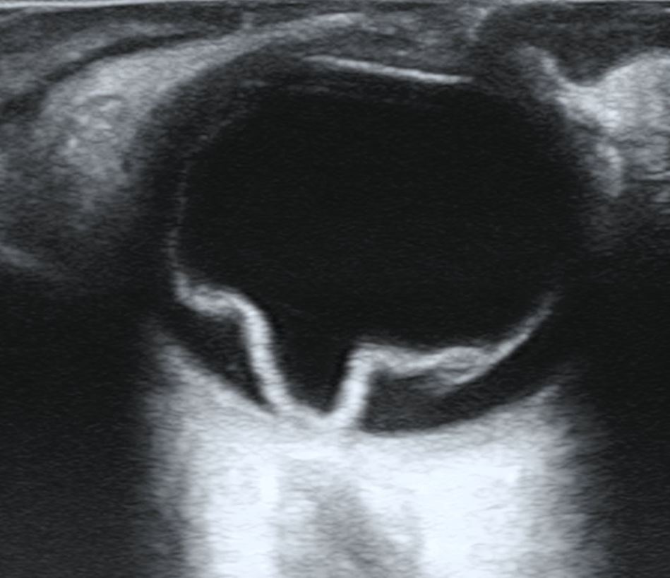 Ocular ultrasound image showing a folded, detached retina