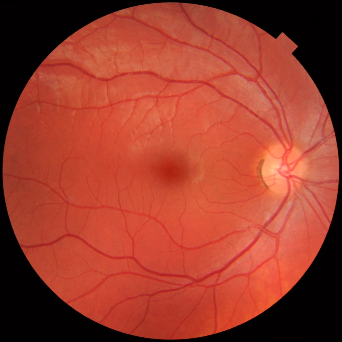 Color fundus photograph of a normal right eye