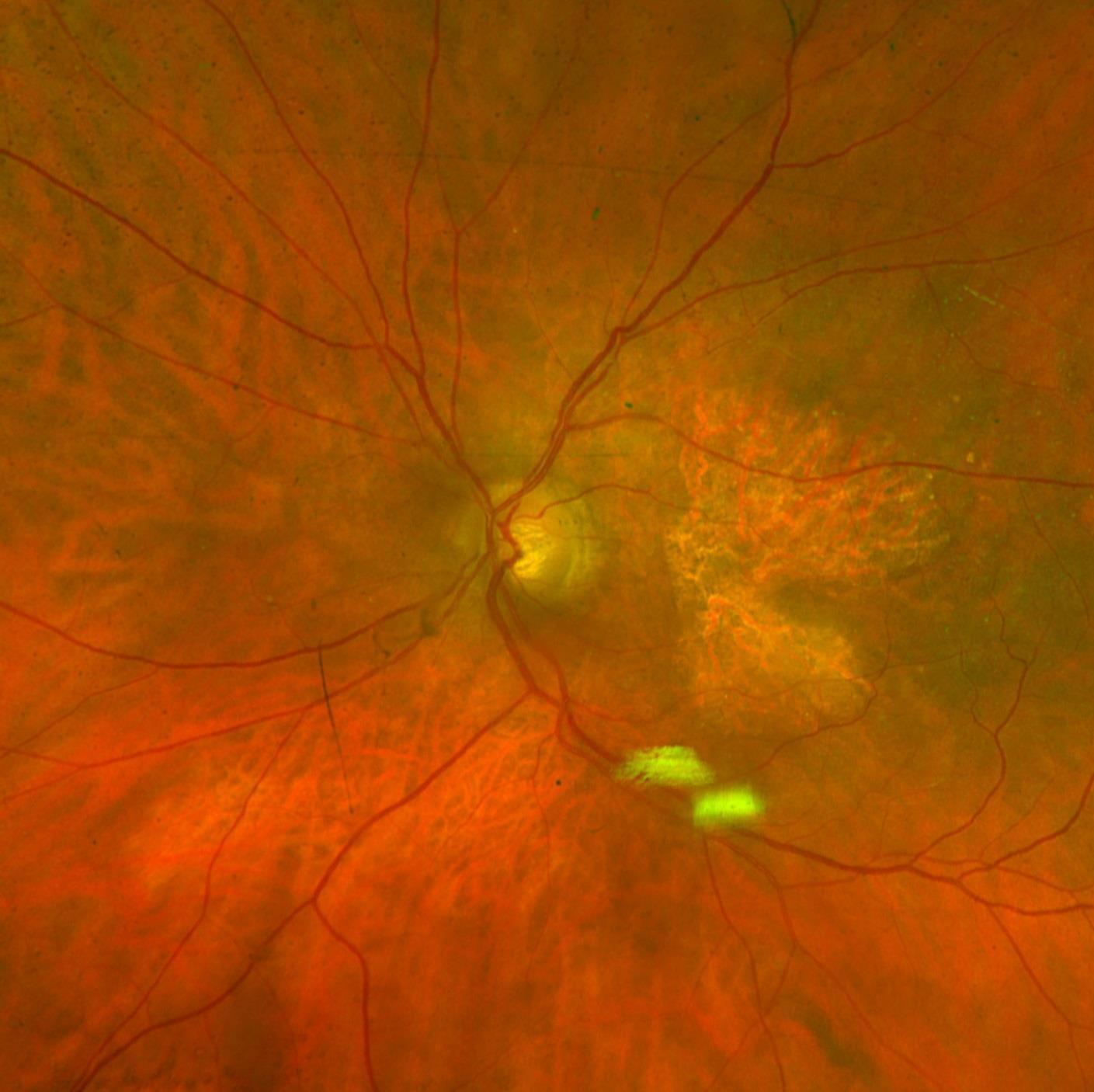 Color fundus photograph showing geographic atrophy in the macula