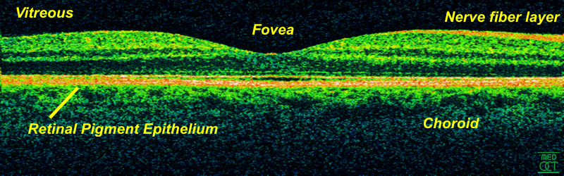 OCT cross-section of the retina with fovea and retinal pigment epithelium labeled