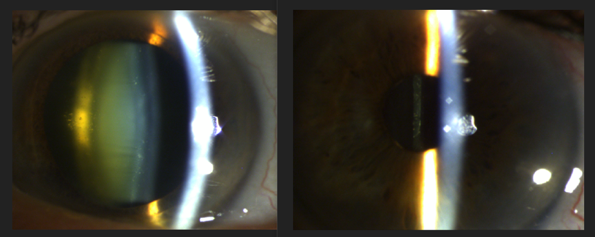 Before-and-after slit-lamp photos showing cataract removed and clear IOL