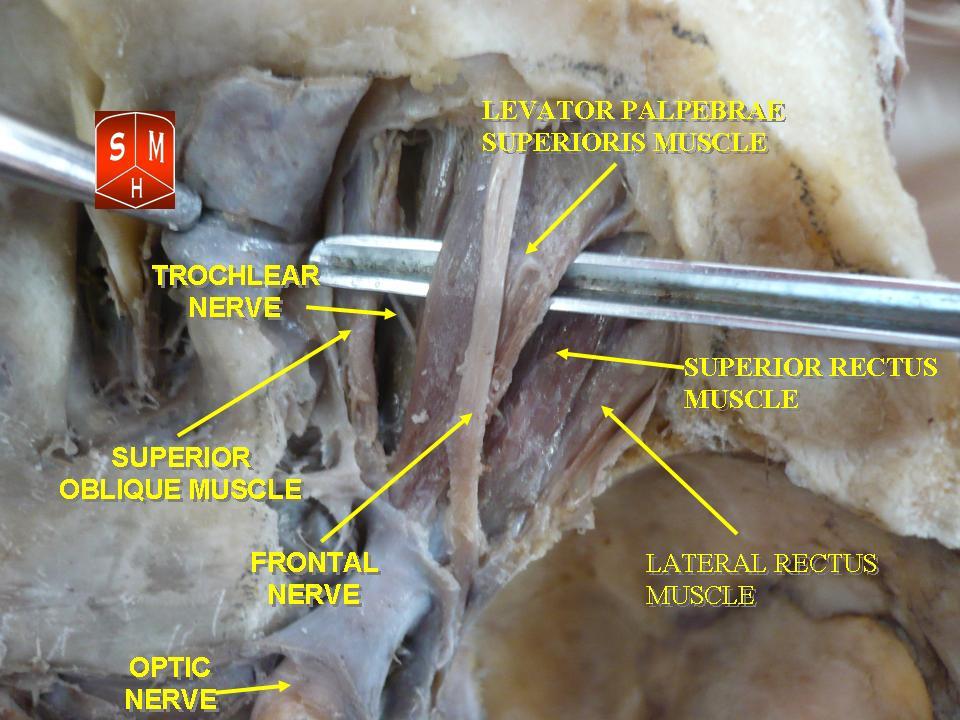 Anatomy illustration of the six extra-ocular muscles around the eyeball.
