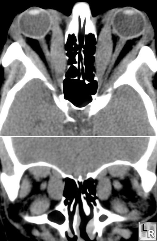 Axial and coronal CT scans showing enlarged extra-ocular muscles in thyroid eye disease.