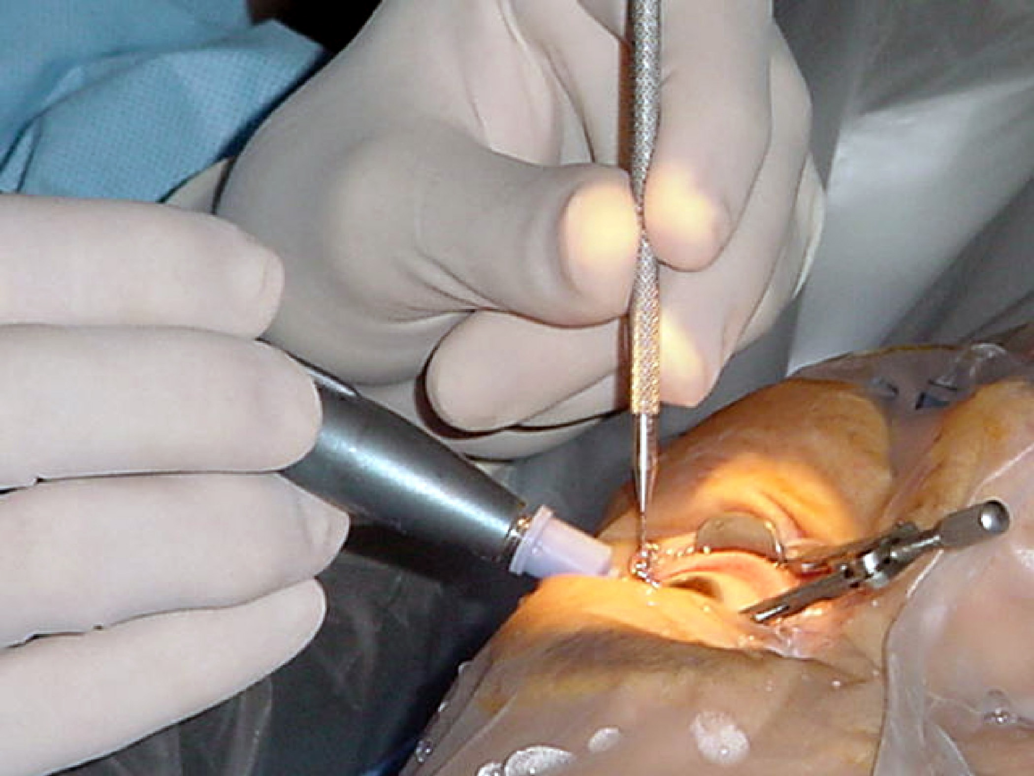 Surgeon inserting an intraocular lens during cataract surgery