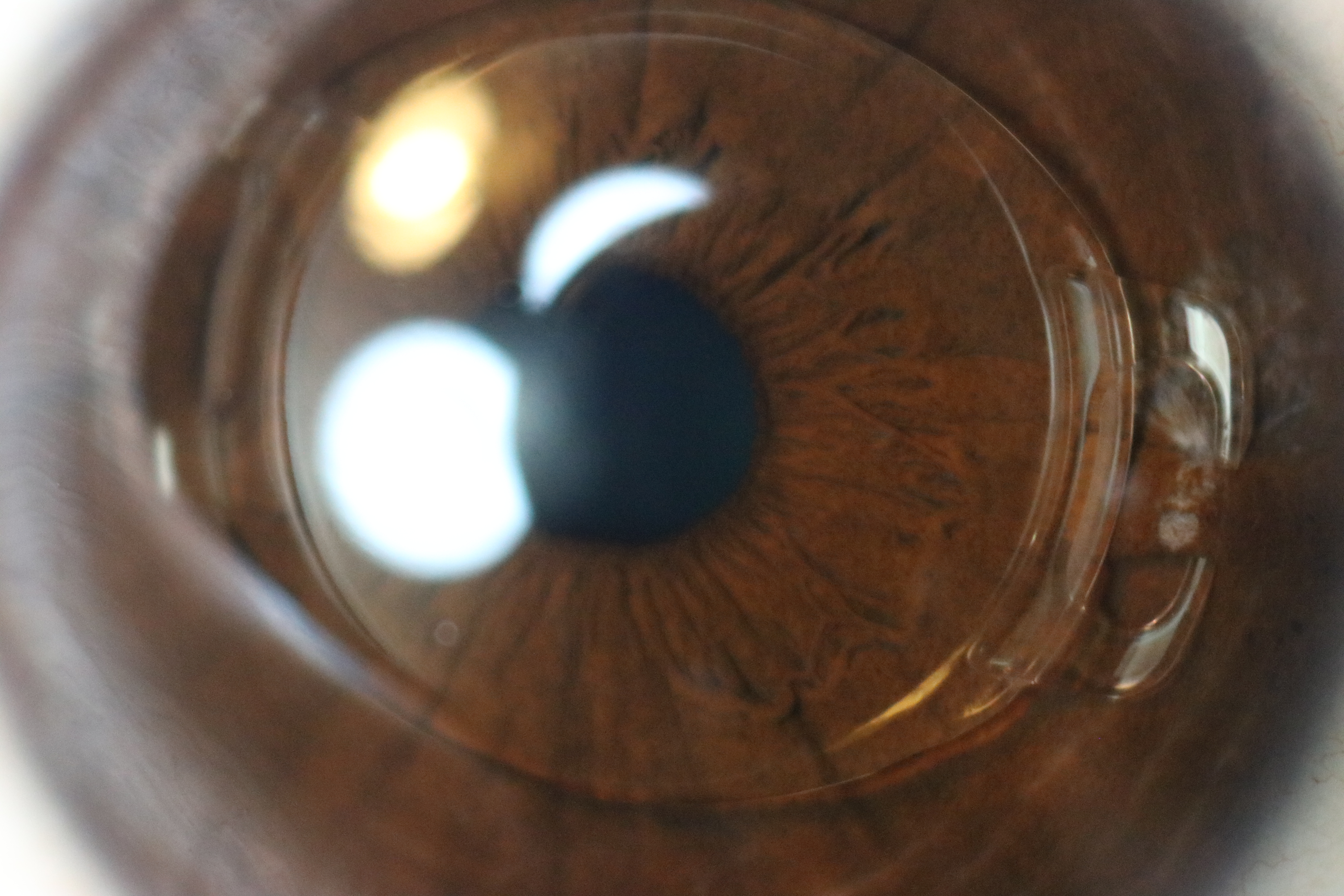Close-up photo showing an intraocular lens inside the eye