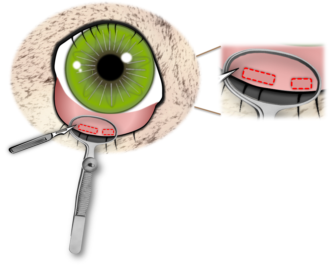 Diagram of lash root excision using a clamp and scalpel
