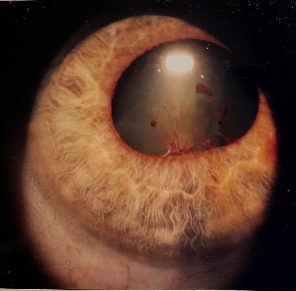 Color photograph of vascularised posterior synechiae causing an irregular pupil.
