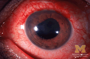 Slit-lamp photograph of anterior uveitis showing ciliary flush and inflammatory cells.