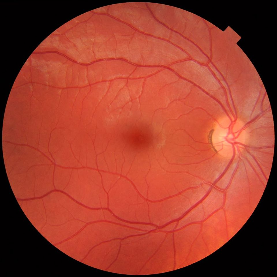 Normal fundus photograph of a healthy right eye