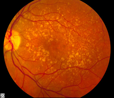 Fundus photo with drusen in intermediate AMD