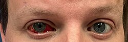 Patient’s eyes shortly after vitrectomy with mild redness