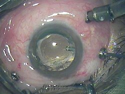 Photograph of a three-port 23-gauge vitrectomy being performed