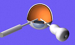 Illustration showing vitrectomy instruments inside the eye