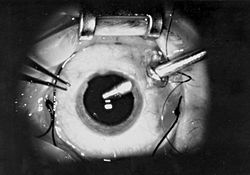 Close-up view of vitrectomy surgical setup