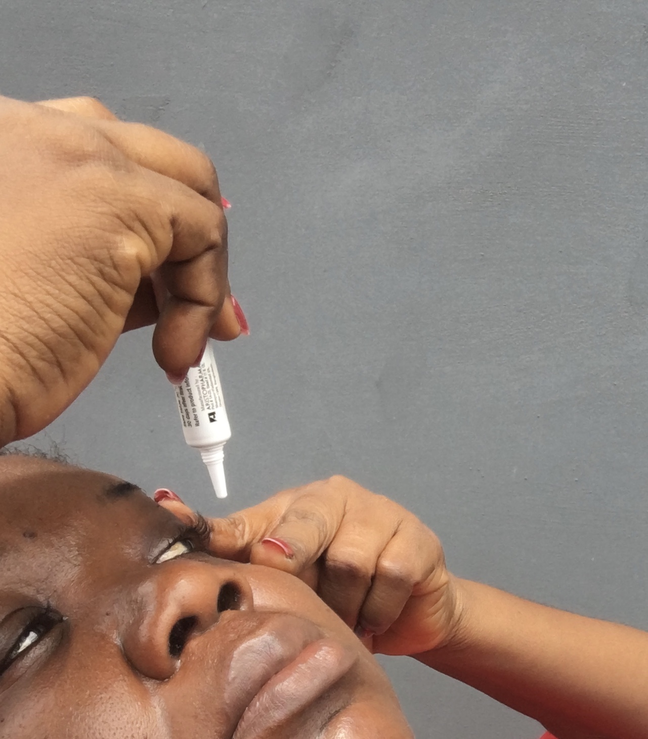 Person instilling an eye drop into the lower eyelid