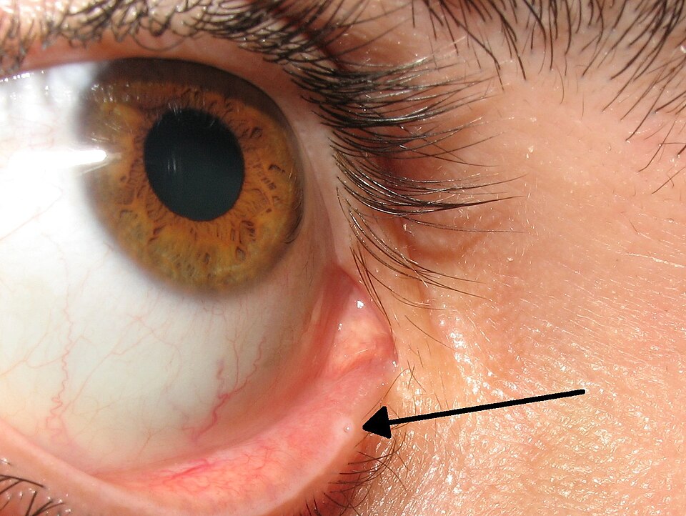 Close-up photo of the lower eyelid showing the lacrimal punctum with an arrow