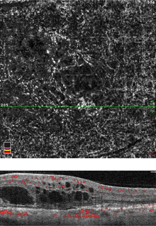 OCT and OCT-angiography composite showing abnormal vessels and intraretinal cysts in neovascular AMD.