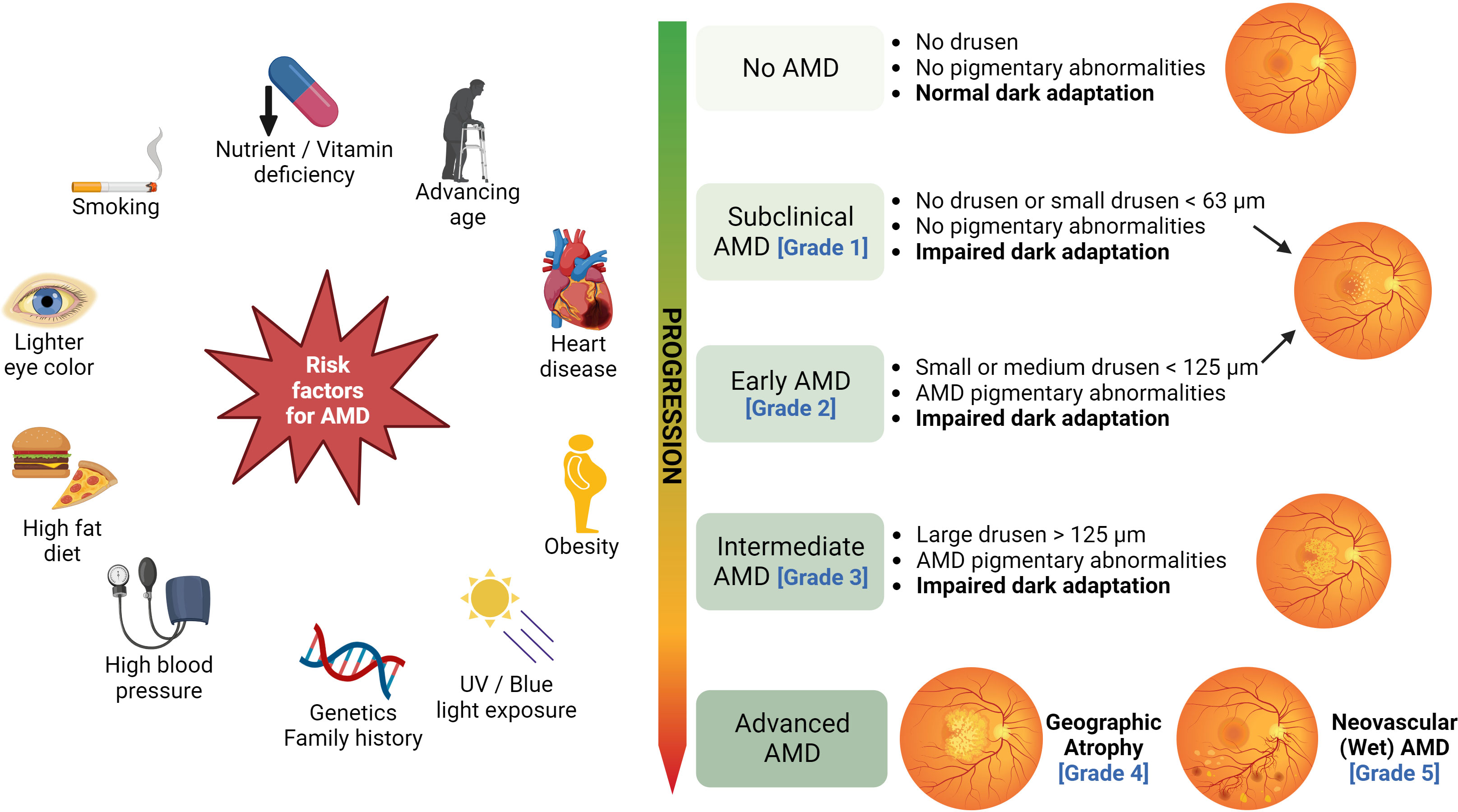 Infographic summarizing AMD risk factors and progression stages.