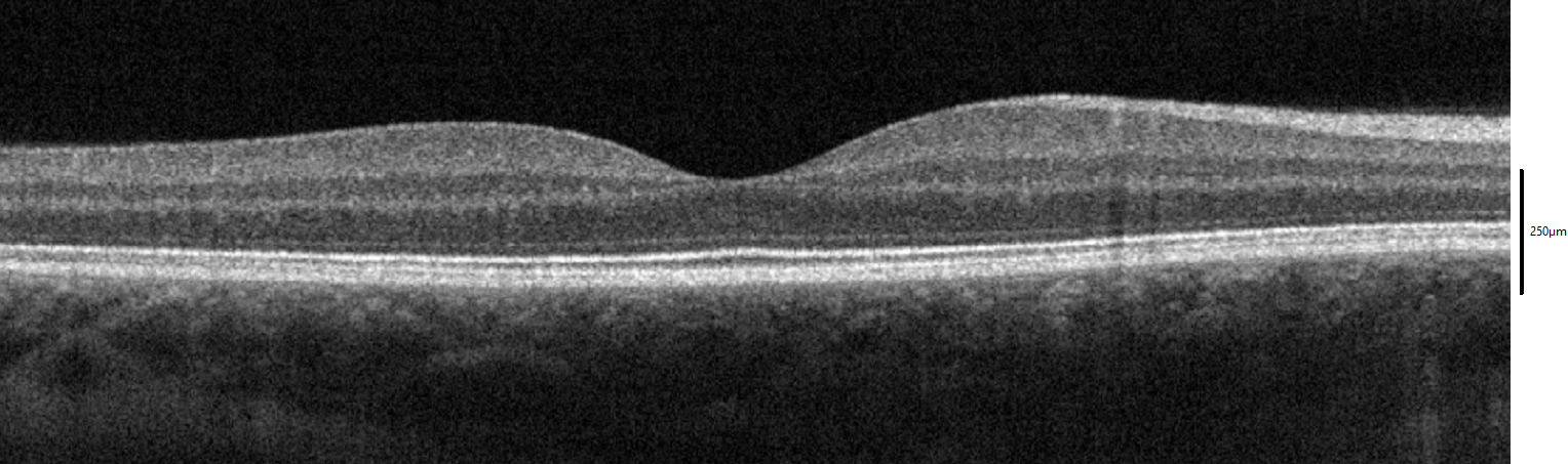 Spectral-domain OCT cross-section of a healthy macula with an English scale bar.