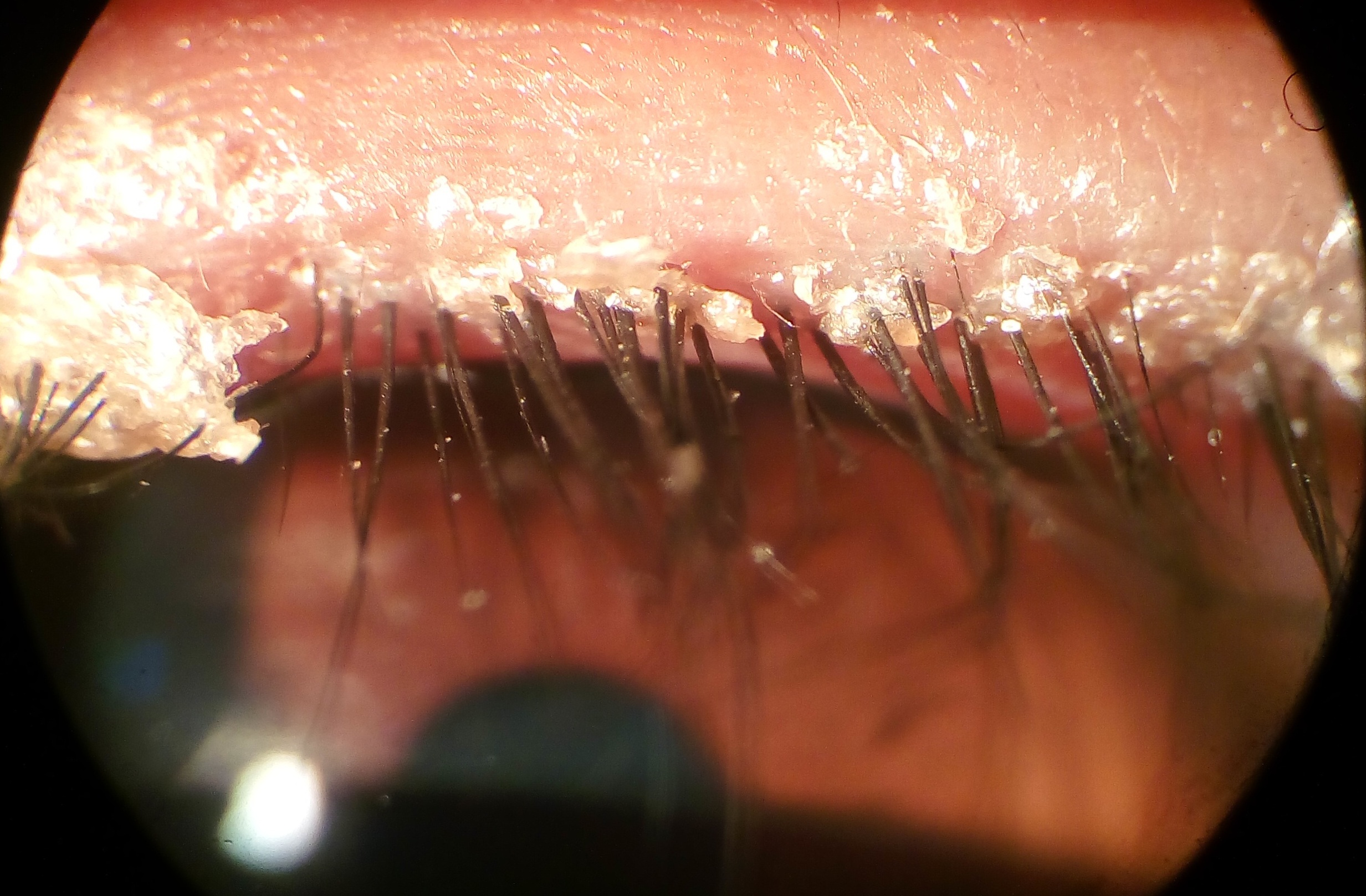 Slit-lamp view showing crusting and collarettes at the lash base